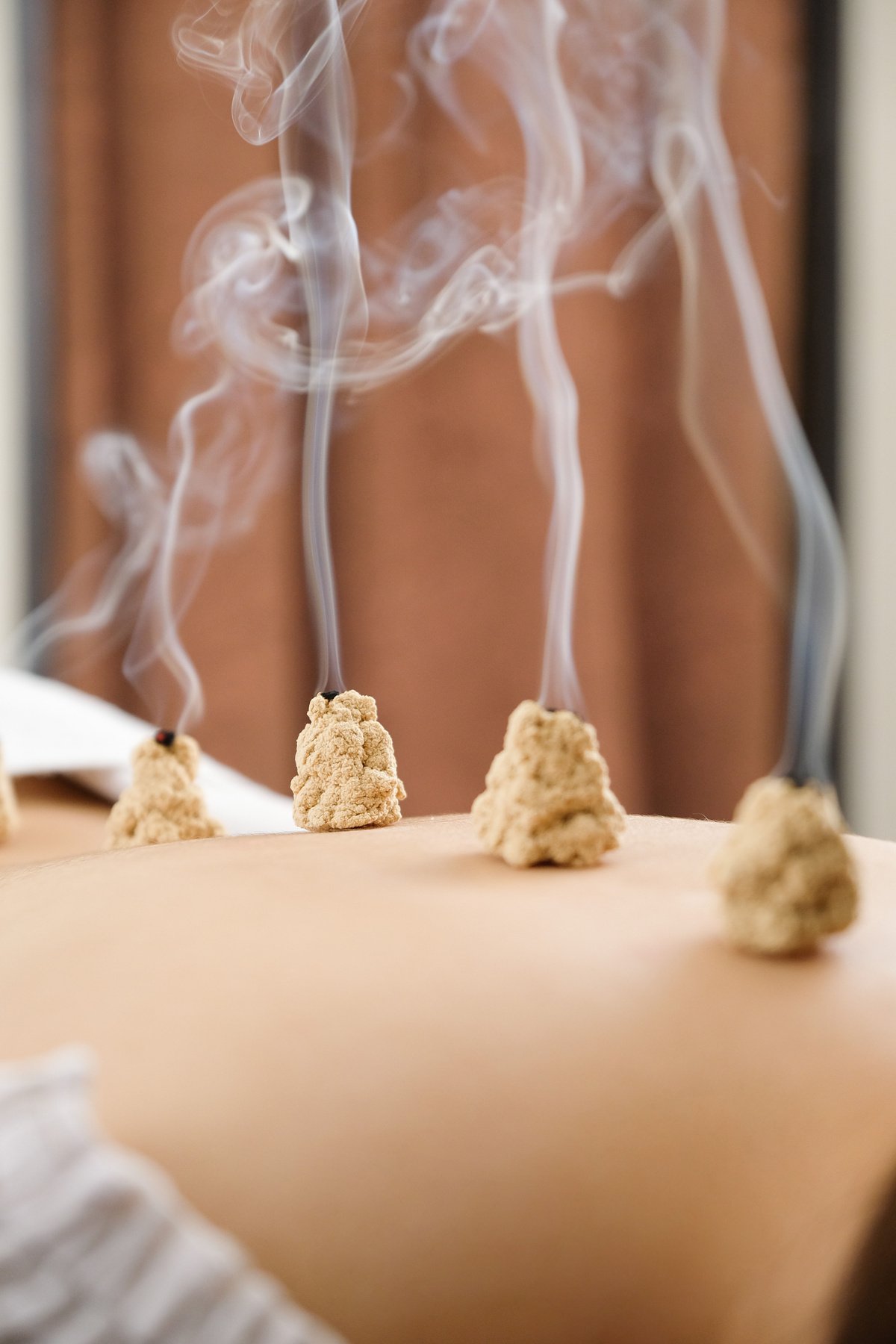 Acupuncture and moxibustion on the back of a woman in a bright acupuncture center