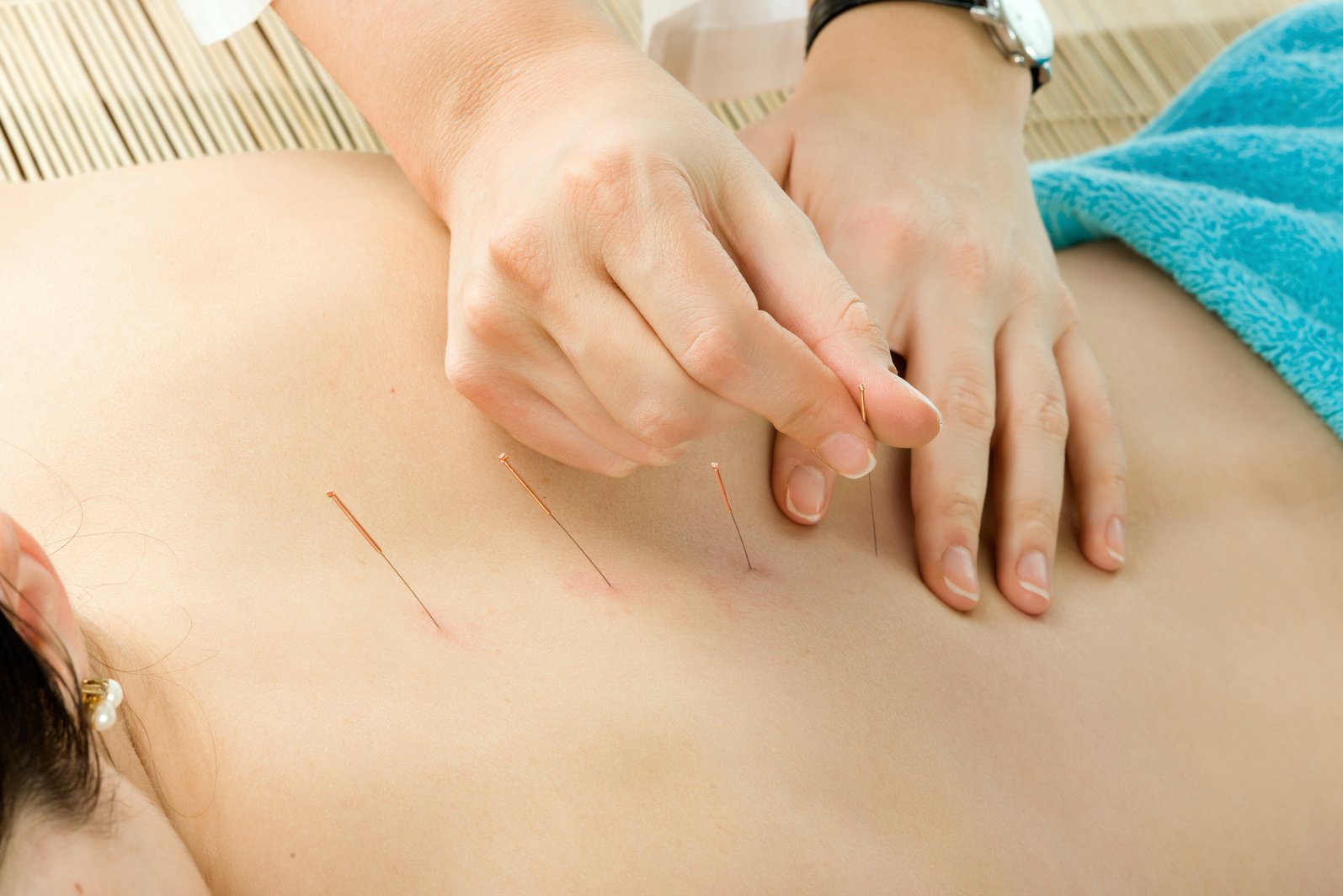 acupuncture